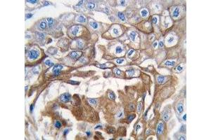 IHC analysis of FFPE human lung carcinoma tissue stained with NRAS antibody (GTPase NRas antibody  (AA 147-179))