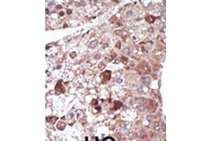 Formalin-fixed and paraffin-embedded human cancer tissue reacted with the primary antibody, which was peroxidase-conjugated to the secondary antibody, followed by DAB staining. (PCK1 antibody  (N-Term))