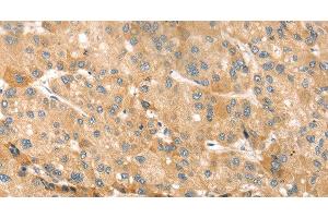 Immunohistochemistry of paraffin-embedded Human liver cancer using EVA1A Polyclonal Antibody at dilution of 1:30 (TMEM166 antibody)