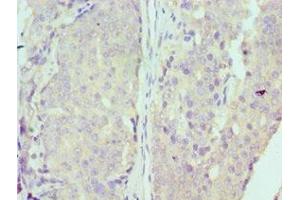 Immunohistochemistry of paraffin-embedded human colon cancer using ABIN7150341 at dilution of 1:100 (MCM7 antibody  (AA 360-719))