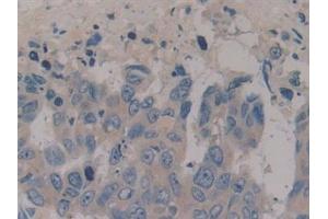 Detection of NPY in Human Breast cancer Tissue using Polyclonal Antibody to Neuropeptide Y (NPY) (NPY antibody  (AA 30-97))