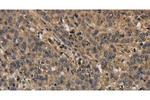 Immunohistochemistry of paraffin-embedded Human liver cancer using KCNN4 Polyclonal Antibody at dilution of 1:40 (KCNN4 antibody)