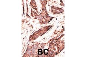 Formalin-fixed and paraffin-embedded human cancer tissue reacted with the primary antibody, which was peroxidase-conjugated to the secondary antibody, followed by AEC staining. (OASL antibody  (C-Term))