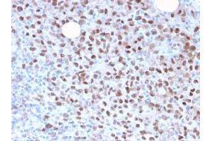 Formalin-fixed, paraffin-embedded human Melanoma stained with MITF Recombinant Rabbit Monoclonal Antibody (MITF/2987R). (Recombinant MITF antibody)
