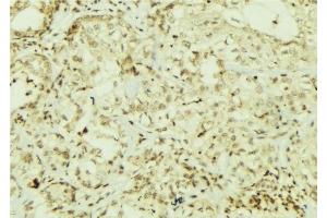 ABIN6267064 at 1/100 staining Human breast cancer tissue by IHC-P. (AKT 1/2/3 antibody  (pTyr312, pTyr315, pTyr316))
