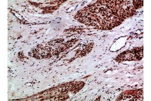 Immunohistochemical analysis of paraffin-embedded human-cervical-cancer, antibody was diluted at 1:200 (Thymopoietin antibody  (AA 1-50))