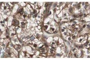 Affinity Purified anti-MAD2L2 antibody shows strong nuclear and cytoplasmic staining of tumor cells in cancerous human kidney tissue. (MAD2L2 antibody  (N-Term))