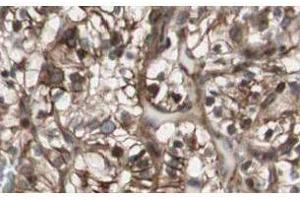 Affinity Purified anti-MAD2L2 antibody shows strong nuclear and cytoplasmic staining of tumor cells in cancerous human kidney tissue.