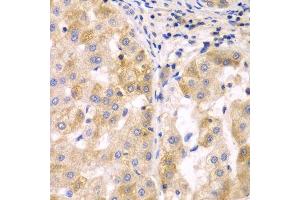 Immunohistochemistry of paraffin-embedded human liver cancer using SULT2B1 antibody. (SULT2B1 antibody  (AA 1-365))