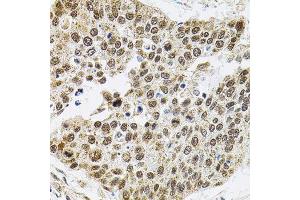 Immunohistochemistry of paraffin-embedded human lung cancer using Smarcd1 antibody (ABIN6003658) (40x lens). (SMARCD1 antibody)