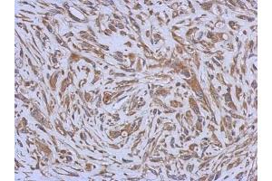 IHC-P Image Immunohistochemical analysis of paraffin-embedded U373 xenograft, using ENTPD3, antibody at 1:500 dilution. (ENTPD3 antibody)