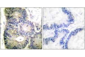 Immunohistochemistry analysis of paraffin-embedded human colon carcinoma tissue, using Cytochrome c Antibody. (Cytochrome C antibody  (AA 10-59))