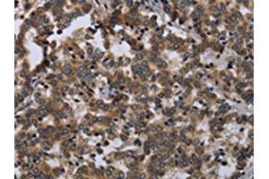The image on the left is immunohistochemistry of paraffin-embedded Human liver cancer tissue using ABIN7129488(FGF18 Antibody) at dilution 1/20, on the right is treated with fusion protein. (FGF18 antibody)
