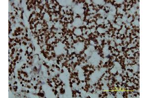 Immunoperoxidase of monoclonal antibody to POU2F2 on formalin-fixed paraffin-embedded human ovary, clear cell carcinoma tissue. (Oct-2 antibody  (AA 1-400))