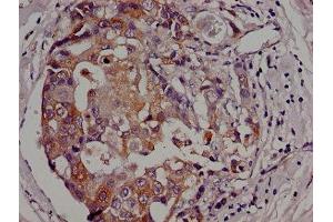 Immunohistochemistry of paraffin-embedded human breast cancer using ABIN7154605 at dilution of 1:100 (Adenylate Kinase 3 antibody  (AA 142-227))