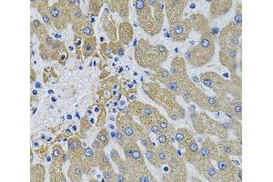 Immunohistochemistry of paraffin-embedded Human liver damage using MBL2 Polyclonal Antibody