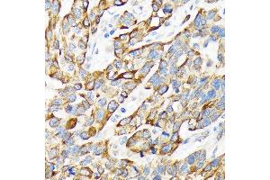 Immunohistochemistry of paraffin-embedded human esophageal cancer using Cytokeratin 16 (KRT16) Rabbit mAb (ABIN7268094) at dilution of 1:100 (40x lens). (KRT16 antibody)