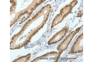 Immunohistochemistry of Human liver cancer using ASH2L Polyclonal Antibody at dilution of 1:50 (ASH2L antibody)