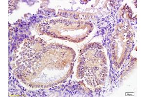 Formalin-fixed and paraffin embedded human endometrium carcinoma labeled with Anti-Signal recognition particle Polyclonal Antibody, Unconjugated (ABIN680228) at 1:200 followed by conjugation to the secondary antibody (Signal Recognition Particle (AA 401-500) antibody)