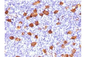 Formalin-fixed, paraffin-embedded human Hodgkin's Lymphoma stained with CD30 Rabbit Polyclonal Antibody.