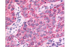 Anti-TAOK1 / TAO1 antibody IHC of human Lung, Non-Small Cell Carcinoma. (TAO Kinase 1 (TAOK1) (Internal Region) antibody)