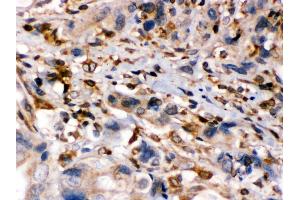 Anti- TAP1 Picoband antibody, IHC(P) IHC(P): Human Intestinal Cancer Tissue (TAP1 antibody  (Middle Region))