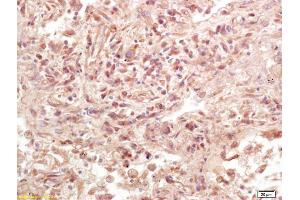 Formalin-fixed and paraffin embedded human lung carcinoma labeled with Anti-Phospho-LAT (Tyr161) Polyclonal Antibody, Unconjugated (ABIN1386362) at 1:200 followed by conjugation to the secondary antibody and DAB staining. (LAT antibody  (pTyr161))