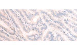Immunohistochemistry of paraffin-embedded Human thyroid cancer tissue using TBC1D2 Polyclonal Antibody at dilution of 1:25(x200) (TBC1D2 antibody)