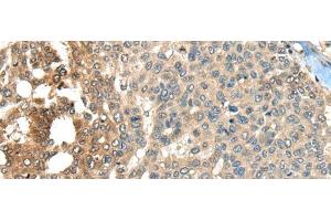 Immunohistochemistry of paraffin-embedded Human liver cancer tissue using MAPK4 Polyclonal Antibody at dilution of 1:35(x200)