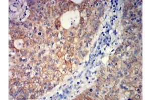 Immunohistochemical analysis of paraffin-embedded stomach cancer tissues using GRM5 mouse mAb with DAB staining. (Metabotropic Glutamate Receptor 5 antibody  (AA 458-580))