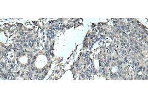 Immunohistochemistry of paraffin-embedded Human colorectal cancer tissue using SLC35F6 Polyclonal Antibody at dilution of 1:95(x200)