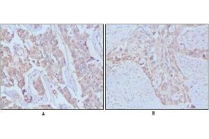 Immunohistochemical analysis of paraffin-embedded human breast cancer,Lung breast tissues using EGF antibody (EGF antibody)