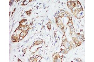 IHC-P: IGF-1 antibody testing of human breast cancer tissue (IGF1 antibody  (Middle Region))