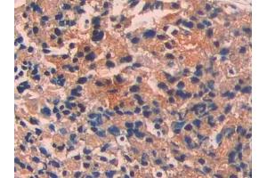 DAB staining on IHC-P; Samples: Human Prostate cancer Tissue (ECT2 antibody  (AA 453-647))
