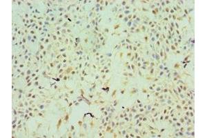 Immunohistochemistry of paraffin-embedded human breast cancer using ABIN7172211 at dilution of 1:100