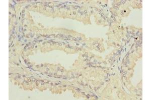 Immunohistochemistry of paraffin-embedded human prostate cancer using ABIN7144813 at dilution of 1:100 (ATL2 antibody  (AA 1-300))