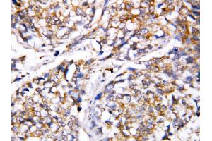 Anti-Caspase 4 antibody, IHC(P) IHC(P): Human Mammary Cancer Tissue (Caspase 4 antibody  (N-Term))