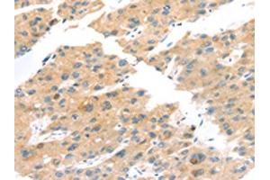 The image on the left is immunohistochemistry of paraffin-embedded Human liver cancer tissue using ABIN7192841(TNK1 Antibody) at dilution 1/20, on the right is treated with synthetic peptide. (TNK1 antibody)