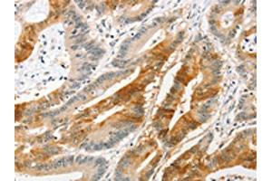 The image on the left is immunohistochemistry of paraffin-embedded Human colon cancer tissue using ABIN7128400(ANAPC2 Antibody) at dilution 1/20, on the right is treated with fusion protein. (ANAPC2 antibody)