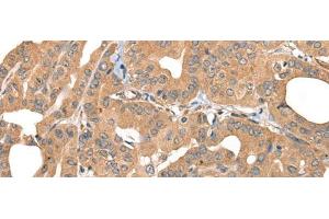 Immunohistochemistry of paraffin-embedded Human thyroid cancer tissue using PPP3R1 Polyclonal Antibody at dilution of 1:55(x200) (PPP3R1 antibody)