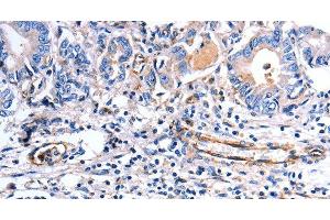 Immunohistochemistry of paraffin-embedded Human stomach cancer using COX11 Polyclonal Antibody at dilution of 1:30 (COX11 antibody)