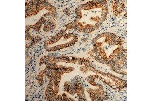 Immunohistochemical analysis of CD49b staining in human colon cancer formalin fixed paraffin embedded tissue section. (ITGA2 antibody  (C-Term))