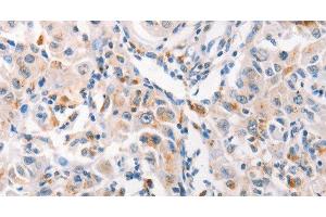 Immunohistochemistry of paraffin-embedded Human liver cancer tissue using MUC2 Polyclonal Antibody at dilution 1:60 (MUC2 antibody)