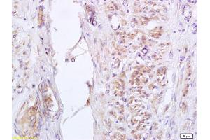 Formalin-fixed and paraffin embedded human cervical carcinoma labeled with Anti-phospho-GADD153 (Ser30) Polyclonal Antibody, Unconjugated (ABIN755977) at 1:200 followed by conjugation to the secondary antibody and DAB staining (DDIT3 antibody  (pSer30))