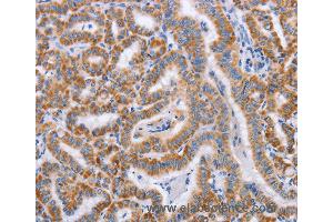 Immunohistochemistry of Human cervical cancer using BST1 Polyclonal Antibody at dilution of 1:50 (BST1 antibody)