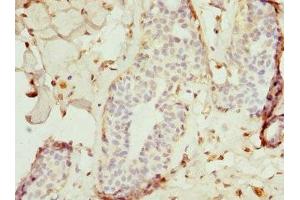Immunohistochemistry of paraffin-embedded human breast cancer using ABIN7172240 at dilution of 1:100 (TRAF4 antibody  (AA 251-470))