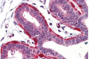 Human Breast (formalin-fixed, paraffin-embedded) stained with SNCG antibody ABIN364362 at 5 ug/ml followed by biotinylated goat anti-rabbit IgG secondary antibody ABIN481713, alkaline phosphatase-streptavidin and chromogen. (SNCG antibody)