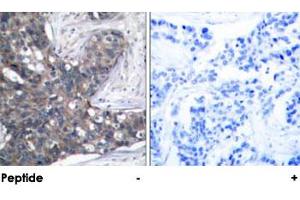 Immunohistochemical analysis of paraffin-embedded human breast carcinoma tissue using EIF2S1 polyclonal antibody . (EIF2S1 antibody)