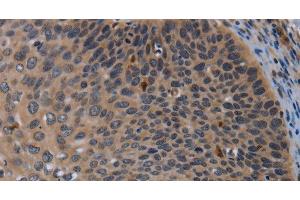 Immunohistochemistry of paraffin-embedded Human cervical cancer using P2RX2 Polyclonal Antibody at dilution of 1:50 (P2RX2 antibody)
