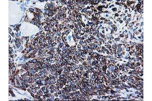 Immunohistochemical staining of paraffin-embedded Adenocarcinoma of Human breast tissue using anti-ALDH3A2 mouse monoclonal antibody.